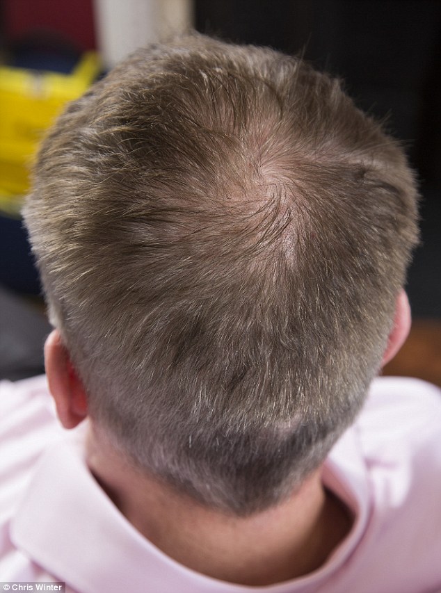 can you regrow hair at temples